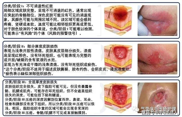 最新壓瘡分期解析及護理策略探討，全面解析壓瘡分期與護理實踐指南